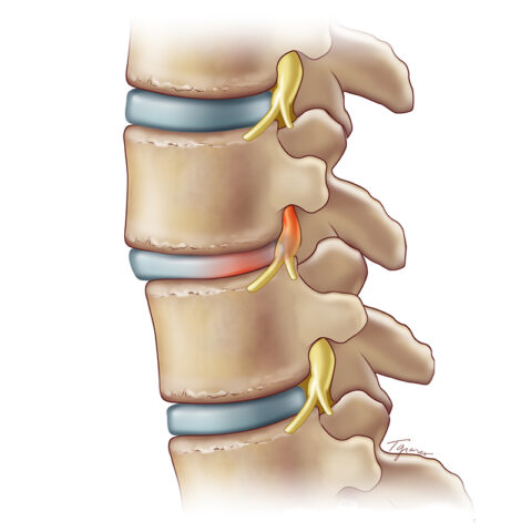 Spondylolisthesis - CESS - Center of excellence in spine surgery